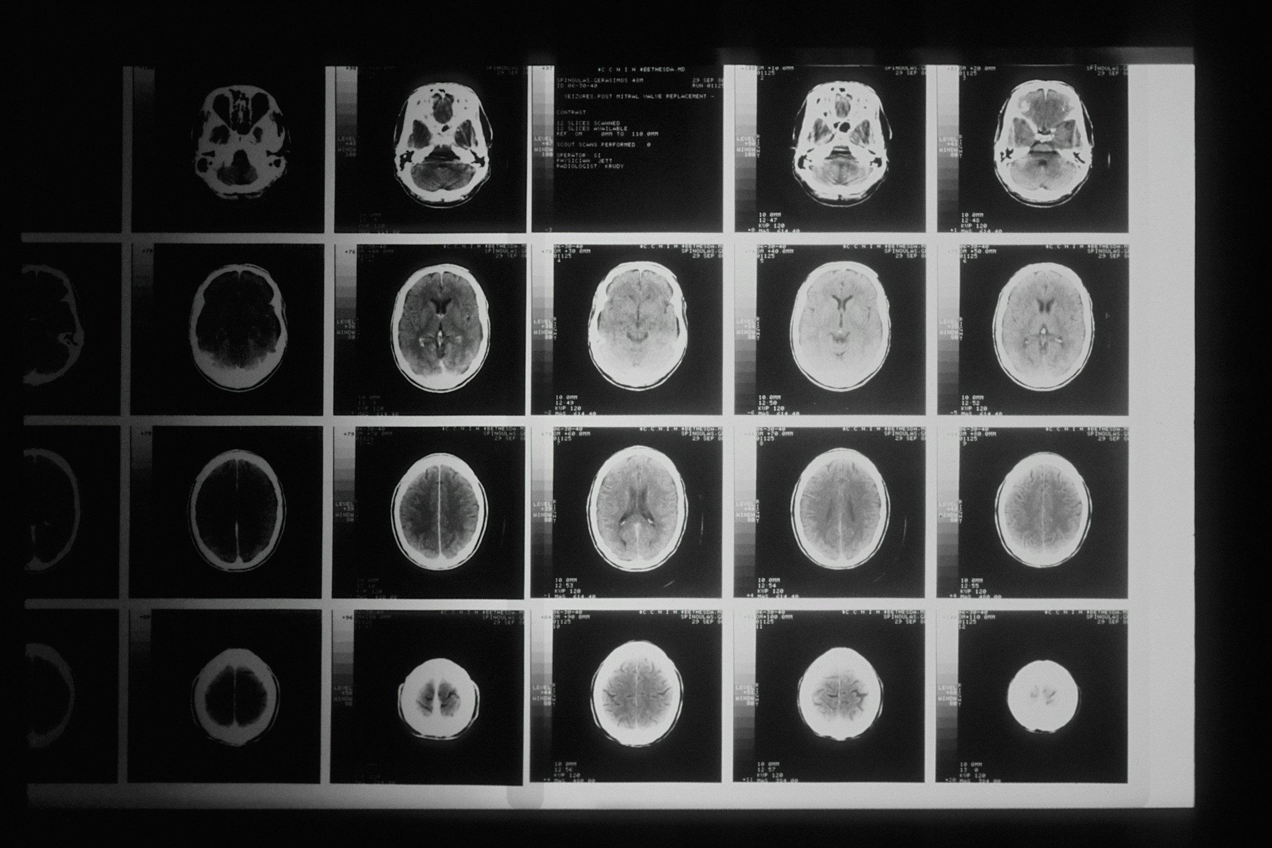 A collection of brain scan images, such as MRI or CT scans, displayed on a lightbox or lighttable in a dark room.